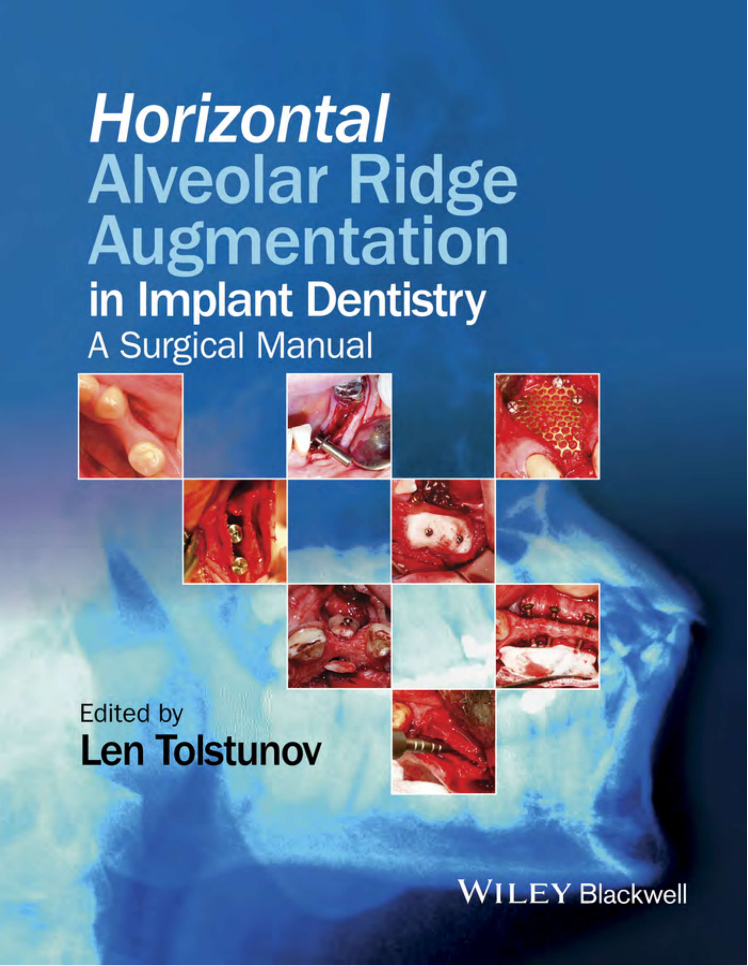 Horizontal Alveolar Ridge Augmentation in Implant Dentistry